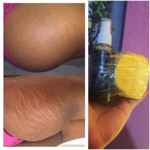Thee Stretch marks treatment set